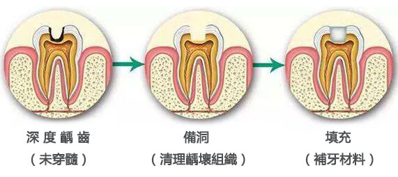 深圳補牙