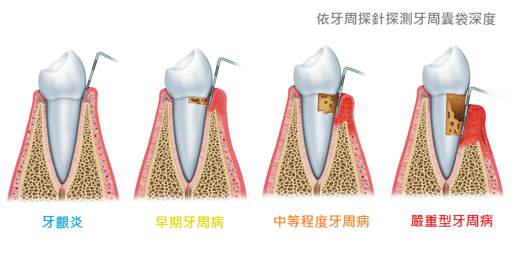 深圳牙周治療