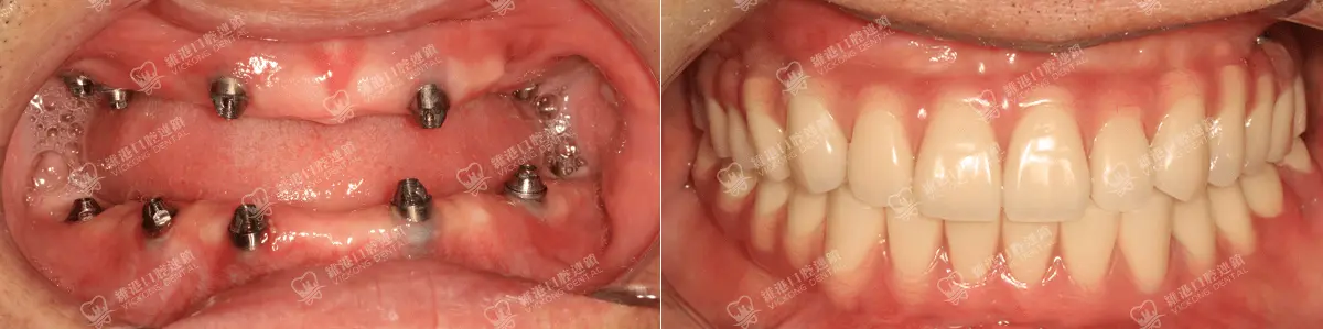 深圳種牙&深圳維港口腔