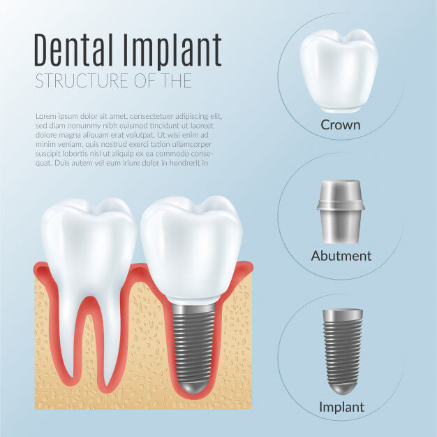 vickongdental_implant1