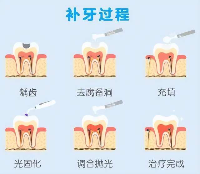 补牙过程