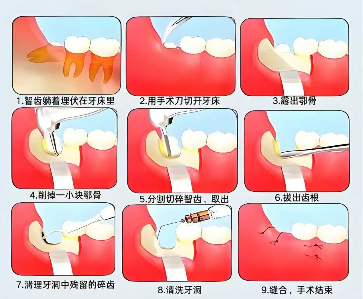 深圳拔智齒 深圳拔智齒