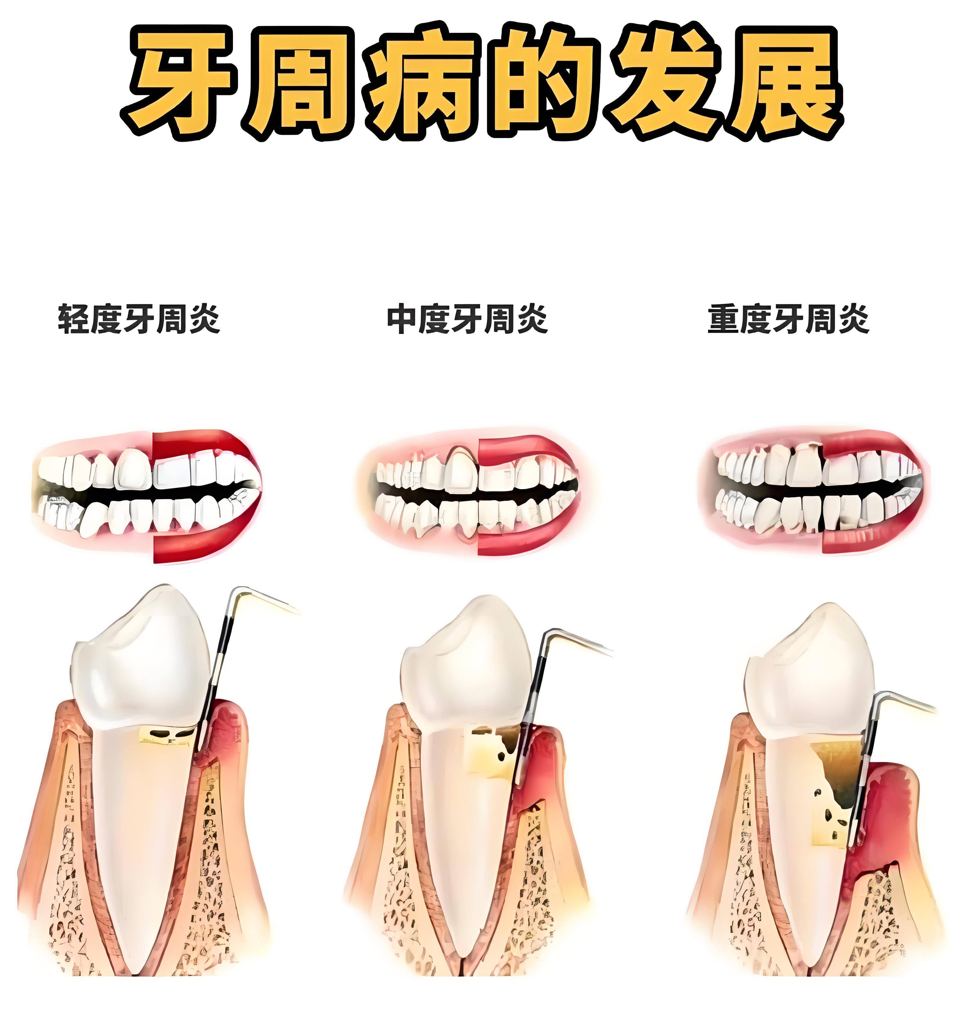 牙周病 牙周病